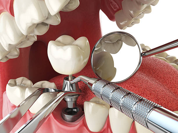 Best Emergency Dentist for Lost Fillings or Crowns in Midvale, UT